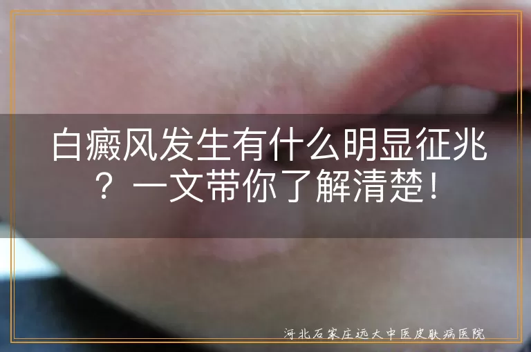 白癜风,征兆,皮肤白斑,白斑变化,边缘表现,感觉变化,毛发变白,心理变化
