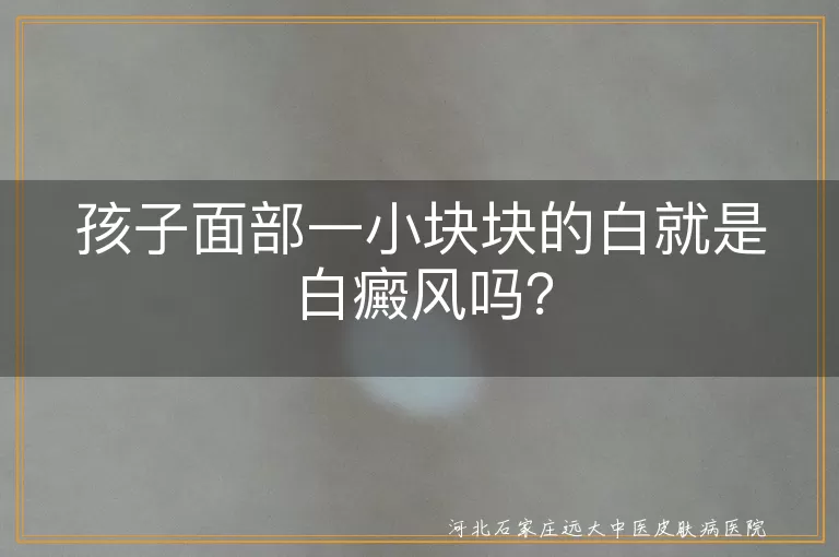 孩子,面部白斑,白癜风,白色糠疹,无色素痣,贫血痣,花斑癣,就医,诊断,治疗
