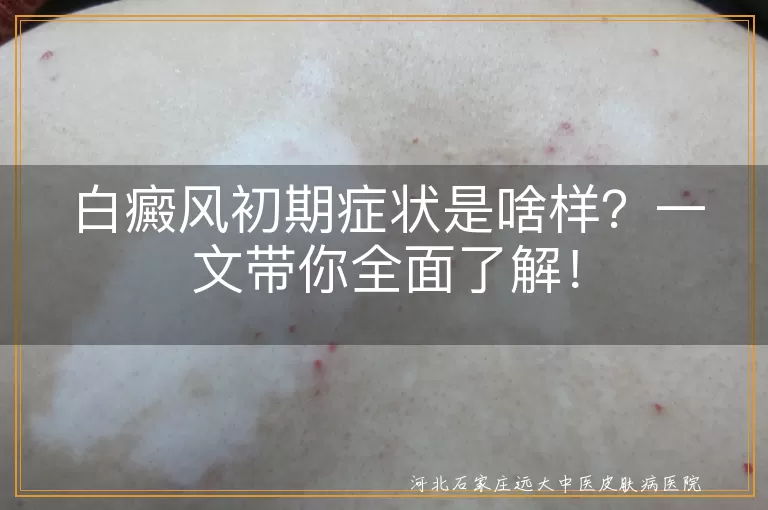 白癜风,初期症状,白斑,黑色素细胞,毛发变白,日晒后反应,心理压力,伍德灯检查,皮肤镜检查,组织病理检查