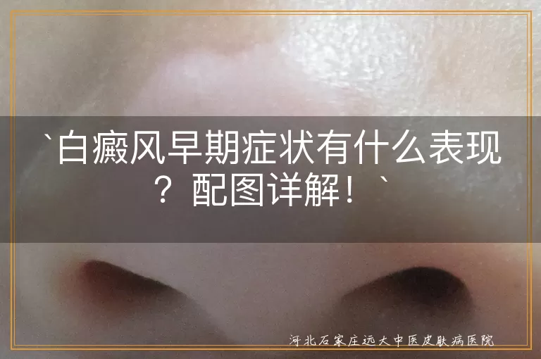 `白癜风,早期症状,白斑,色素减退,感觉异常,形状不规则,逐渐增多,阳光影响`