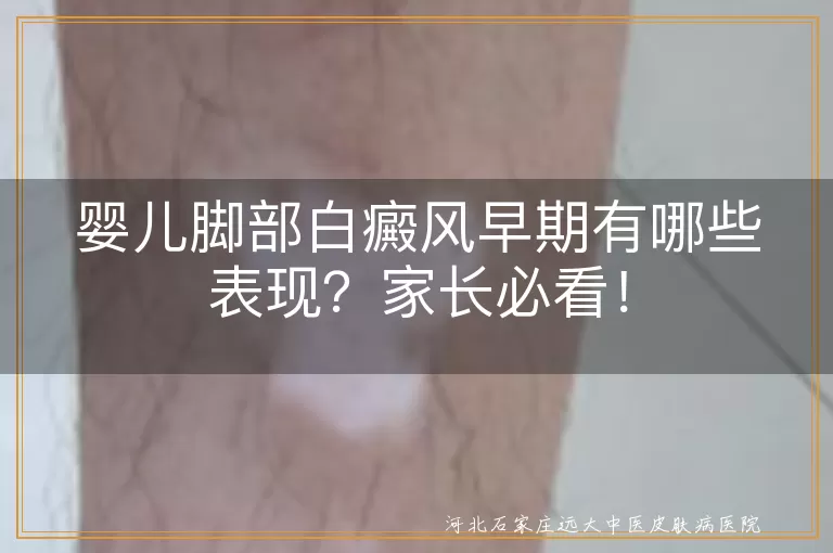 婴儿,脚部,白癜风,早期表现,白斑,治疗,预防