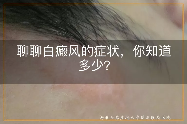 白癜风,症状,白斑,颜色,形状,感觉,位置,变化,预防
