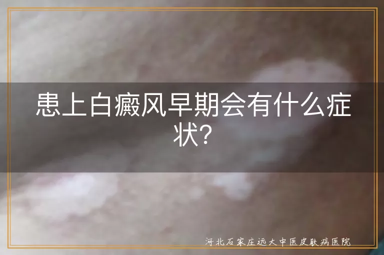 白癜风,早期症状,白斑,皮肤感觉变化,边缘模糊,颜色变化,毛发变白,对称分布,日晒后反应