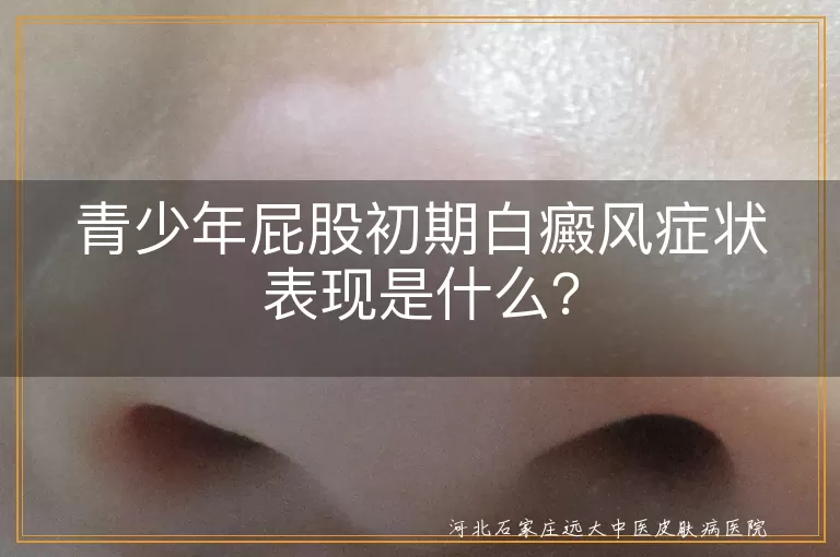 青少年,屁股,白癜风,初期症状,白斑,颜色变化,感觉异常,边界清晰,无鳞屑,无萎缩