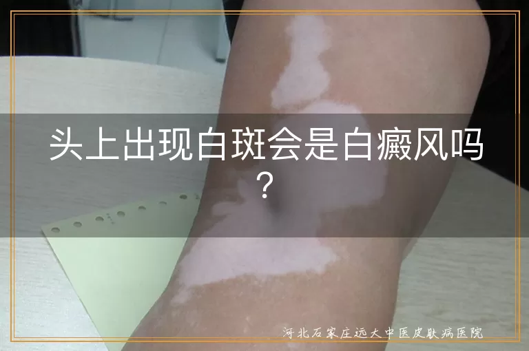头上白斑,白癜风,不良生活习惯,头癣,斑驳病,白色糠疹,确诊,治疗,防晒