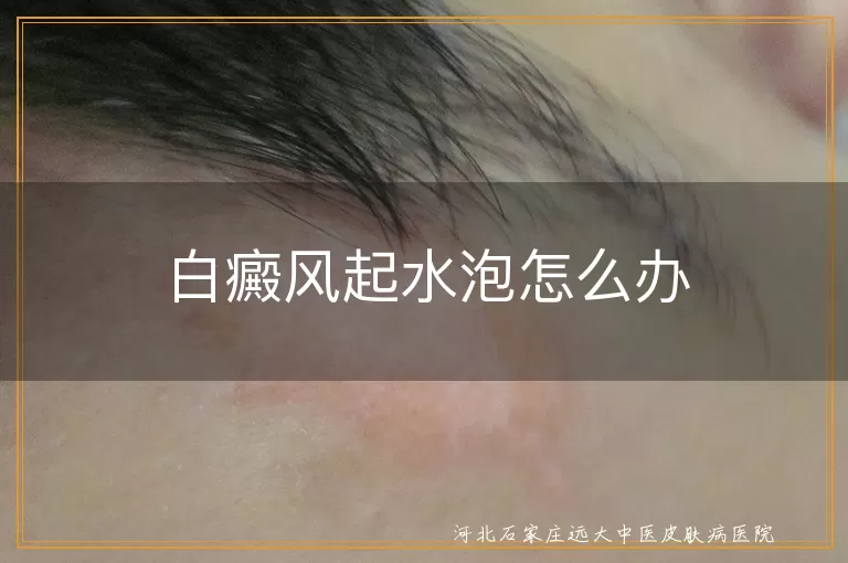 白癜风,水泡,就医,治疗,护理,心态