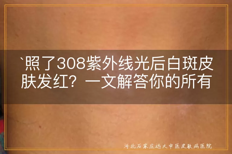 `308紫外线光治疗,白斑,皮肤发红,冷敷,保湿,防晒,遵循医嘱`