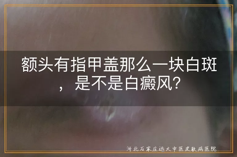 额头白斑,白癜风,花斑癣,微量元素缺乏,皮肤老化,白色糠疹,及时就医,遵医嘱治疗