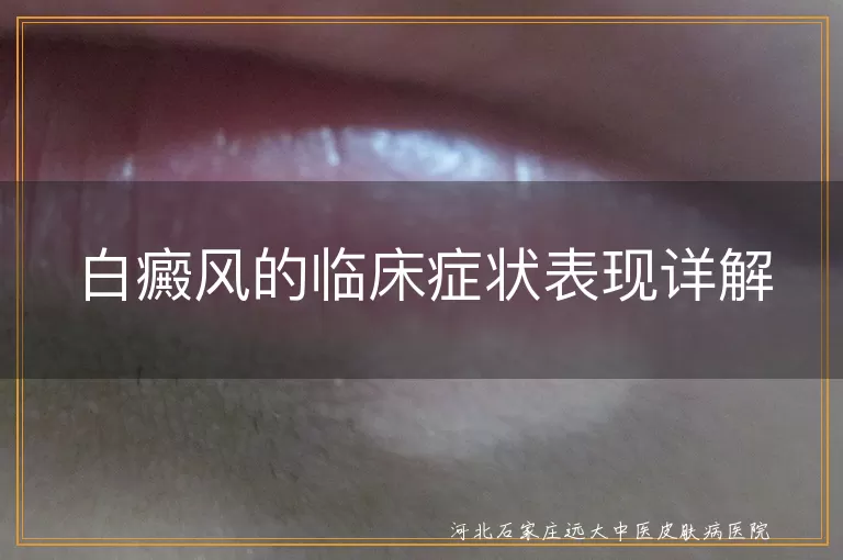 白癜风,白斑,症状,边缘清晰,毛发变白,瘙痒,扩散,融合