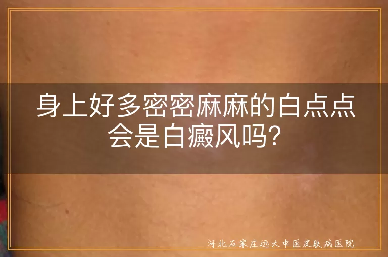 白癜风,白点点,银屑病,白色糠疹,花斑癣,贫血痣,特发性点状白斑,炎症后色素减退