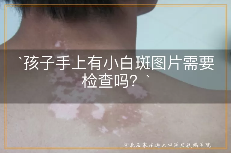 `孩子,小白斑,色素减退,皮肤病,医院检查,皮肤健康,预防`