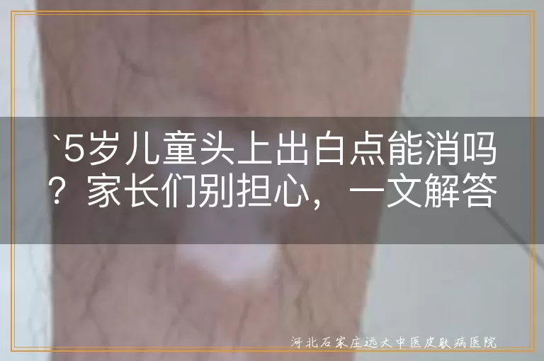 `5岁儿童`,`头上白点`,`头皮屑`,`脂肪粒`,`真菌感染`,`清洁`,`饮食`,`看医生`