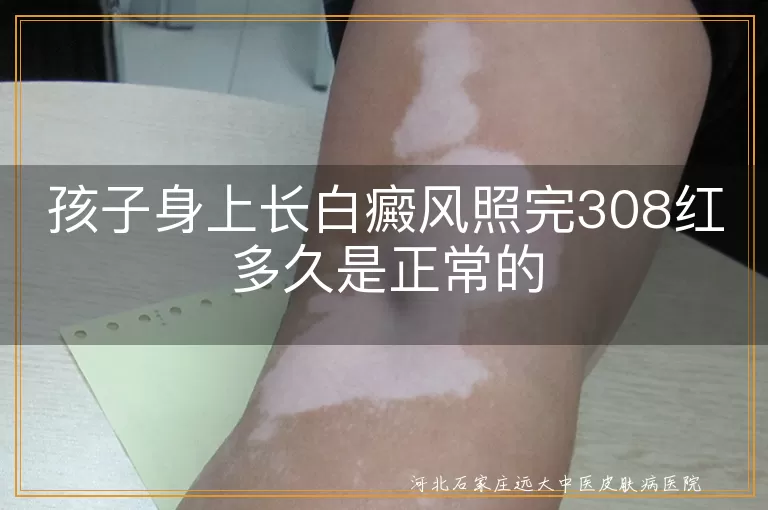 白癜风,308激光,皮肤发红,日常护理,心理疏导,治疗时间