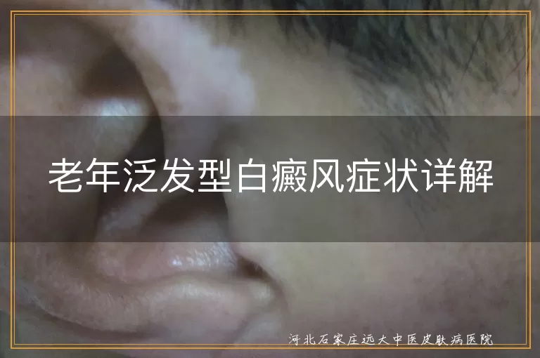 老年泛发型白癜风,白斑面积大,发展迅速,界限分明,毛发变白,并发症,心理压力大,专业治疗