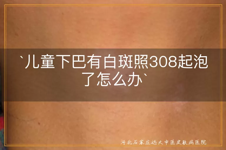 `儿童白斑,308激光,水泡处理,预防感染,医生沟通`