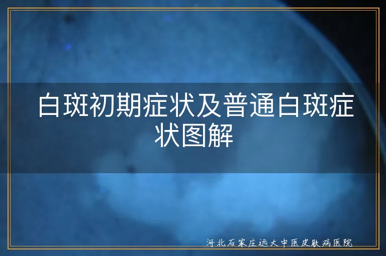 白斑初期症状,普通白斑症状,白癜风,花斑癣,贫血痣,就医,治疗,心态