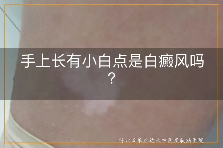 手上小白点,白癜风,皮肤老化,汗斑,手癣,湿疹,白色糠疹,扁平疣,专业检查,治疗