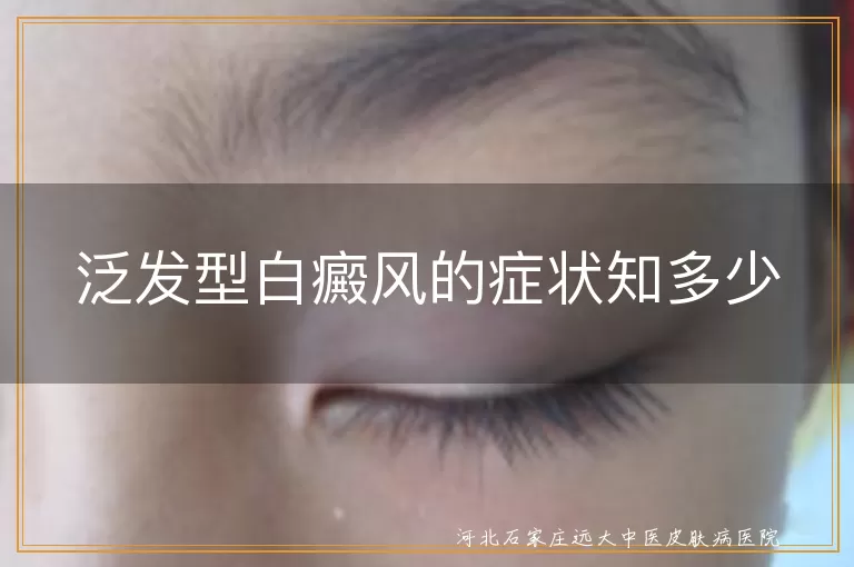 泛发型白癜风,皮肤发白,瘙痒刺痛,毛发变白,红肿脱屑,全身症状