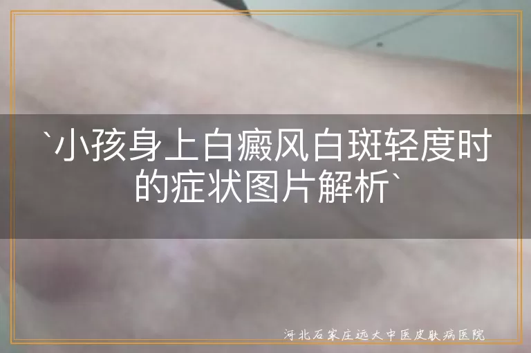 小孩,白癜风,白斑,轻度症状,图片,就医,预防