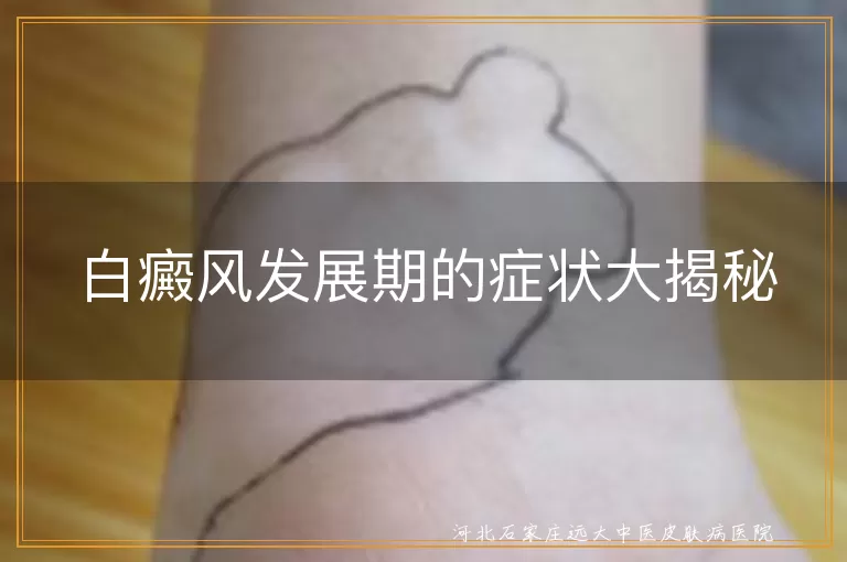 白癜风发展期,白斑变化,同形反应,毛发变白,扩散环,瘙痒疼痛,日常护理