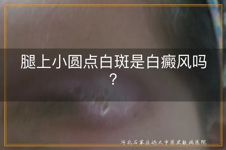 腿上白斑,白癜风,皮肤老化,皮肤干燥,真菌感染,白色糠疹,无色素痣,贫血痣,就医,治疗