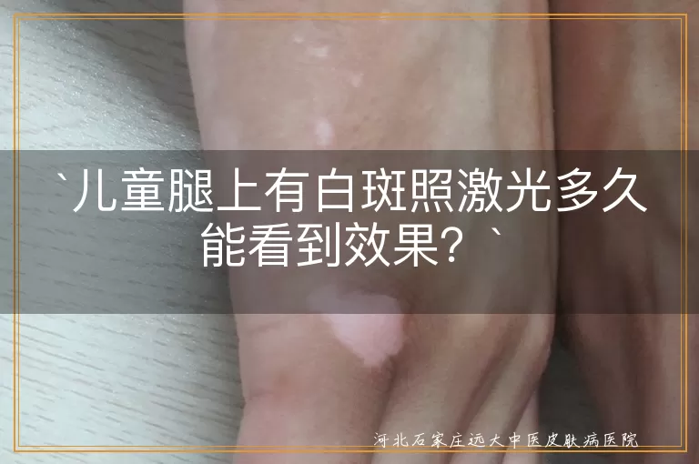 儿童白斑,激光治疗,308nm准分子激光,见效时间,个体差异,治疗方案,防晒,局部护理,饮食调整,情绪管理