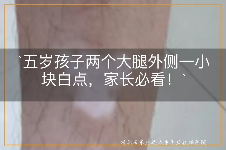 `五岁孩子,大腿外侧,白点,皮肤干燥,紫外线照射,特发性点状白斑,看医生,日常护理`