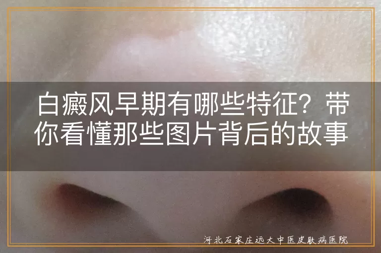 白癜风,早期特征,白斑,扩散,无痛无痒,治疗