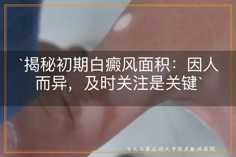 初期白癜风,面积差异,个性化治疗,早发现早治疗,心态调整
