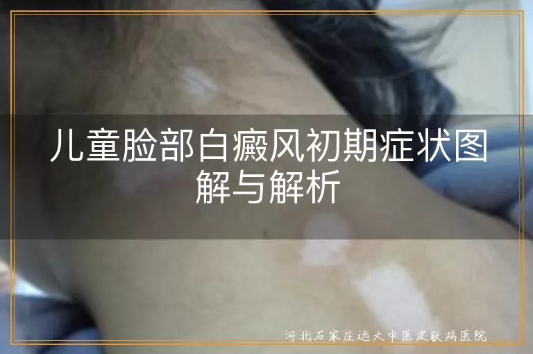 儿童白癜风,脸部初期症状,颜色变化,面积扩散,表面光滑,阳光敏感,专业检查