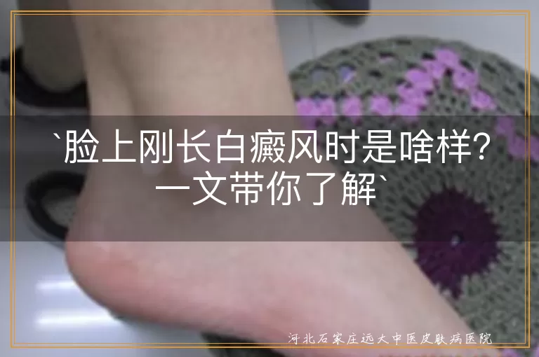 白癜风,脸上,斑块,颜色淡,无鳞屑,无萎缩,扩大,融合,及时就医,治疗方案