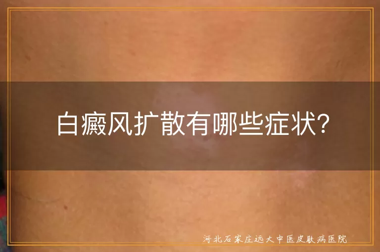 白癜风,扩散,症状,皮肤颜色减退,白斑增多,毛发变白,红肿疼痛,感觉异常