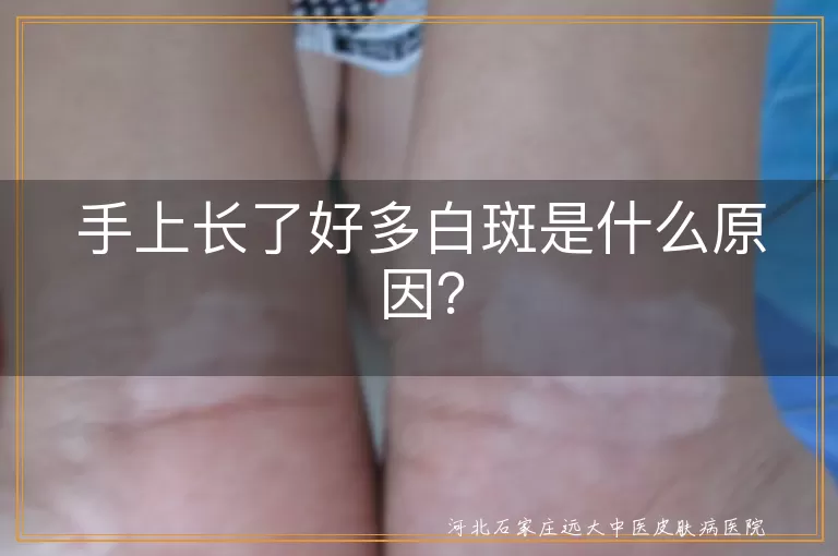 手上白斑,晒伤,皮肤老化,营养素缺乏,皮肤病,遗传因素,内分泌失调,精神压力,生活习惯