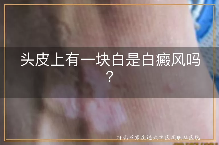 头皮白块,白癜风,银屑病,头皮糠疹,脂溢性皮炎,头癣,伍德灯检查,日常护理