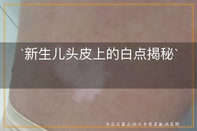 新生儿,头皮白点,粟粒疹,湿疹,白色糠疹,皮脂腺分泌物,胎脂,就医咨询