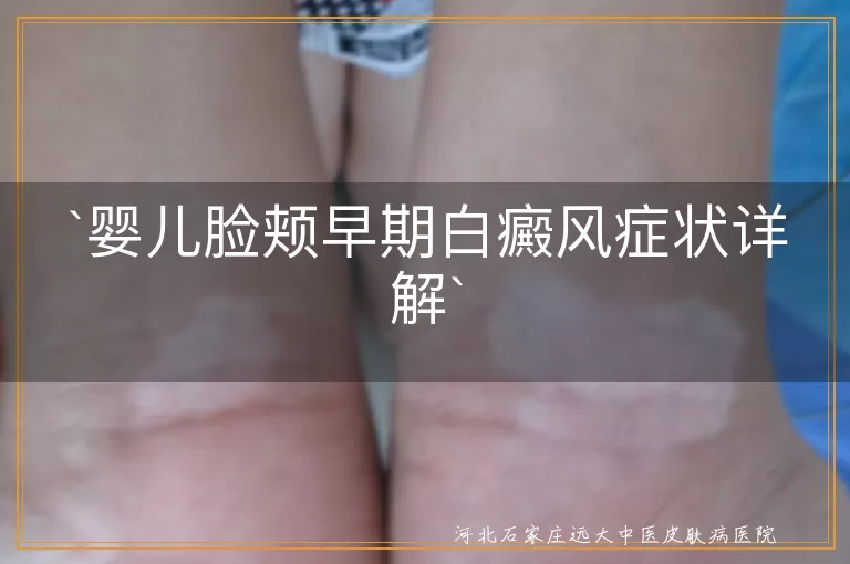 婴儿脸颊,白癜风,早期症状,皮肤变白,毛发变化,瘙痒感,鉴别,应对措施