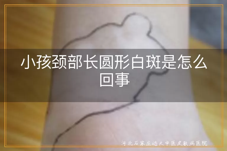 小孩颈部,长圆形白斑,白色糠疹,白癜风,花斑糠疹,营养不良,维生素缺乏,真菌感染,微量元素缺乏,日常护理