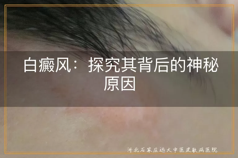 白癜风,遗传因素,环境因素,免疫系统失调,精神因素,微量元素缺乏,外伤,工业污染,预防,治疗