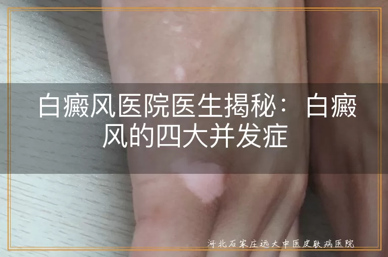 白癜风,并发症,糖尿病,自身免疫性疾病,牙齿问题,心理问题