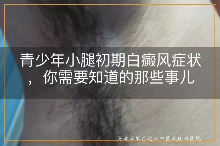青少年,小腿,白癜风,初期症状,皮肤,小白斑,预防,治疗