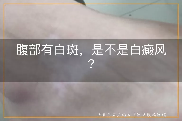 腹部白斑,白癜风,花斑癣,白色糠疹,无色素痣,贫血痣,诊断,治疗,生活习惯,饮食习惯