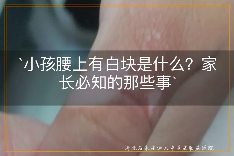 小孩腰上白块,色素减退斑,白癜风,花斑糠疹,白色糠疹,营养不良,无色素痣,贫血痣,就医,日常护理