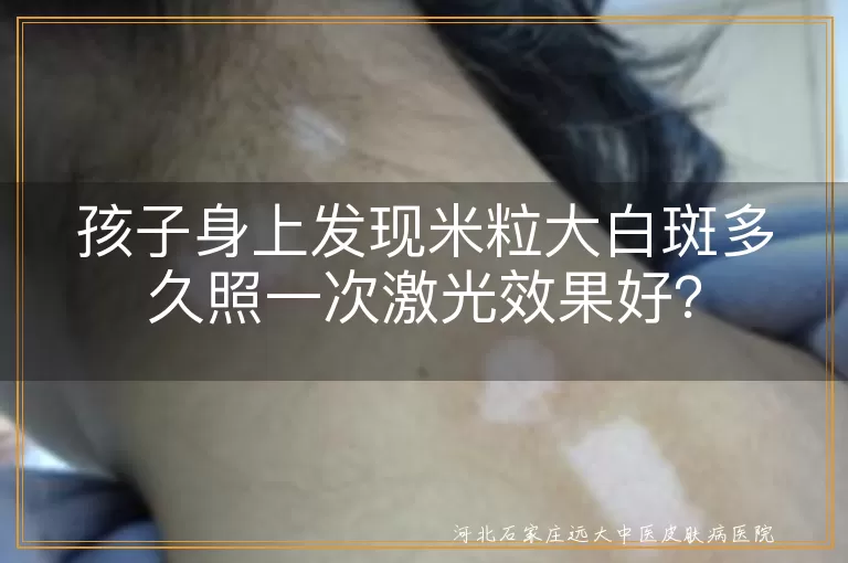 白斑,激光治疗,照射频率,诱发因素,合理饮食,心理支持