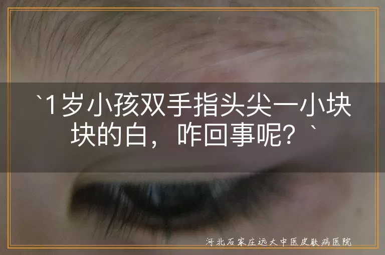 `1岁小孩`,`手指头尖`,`白斑`,`皮肤干燥`,`营养不均衡`,`真菌感染`,`保湿护理`,`日常护理`
