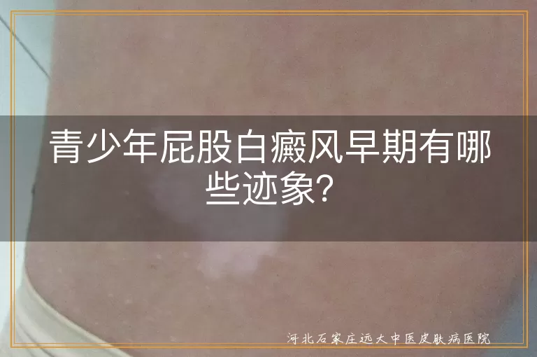 青少年,屁股白癜风,早期迹象,皮肤颜色变化,皮肤感觉异常,白斑扩散,伴随症状,家族史,心理变化