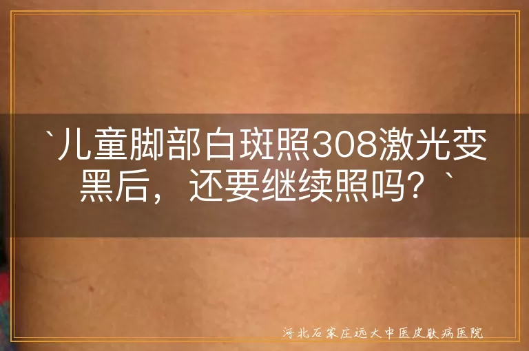 `儿童脚部白斑`,`308激光`,`治疗效果`,`医生建议`,`皮肤保护`