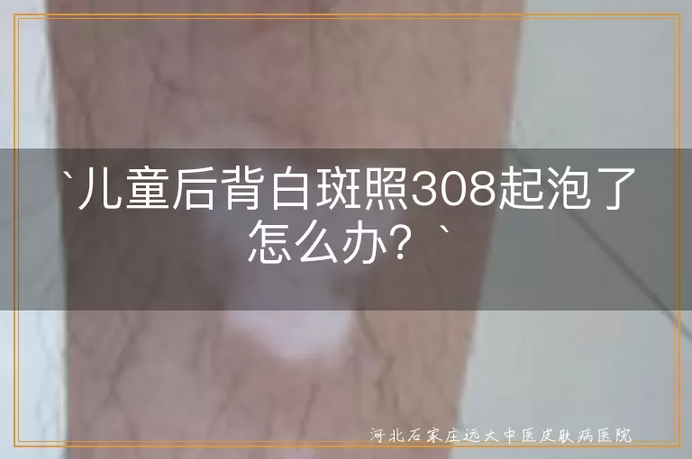 儿童白斑,308激光,水泡处理,预防感染,治疗方案调整,日常护理,心态调整