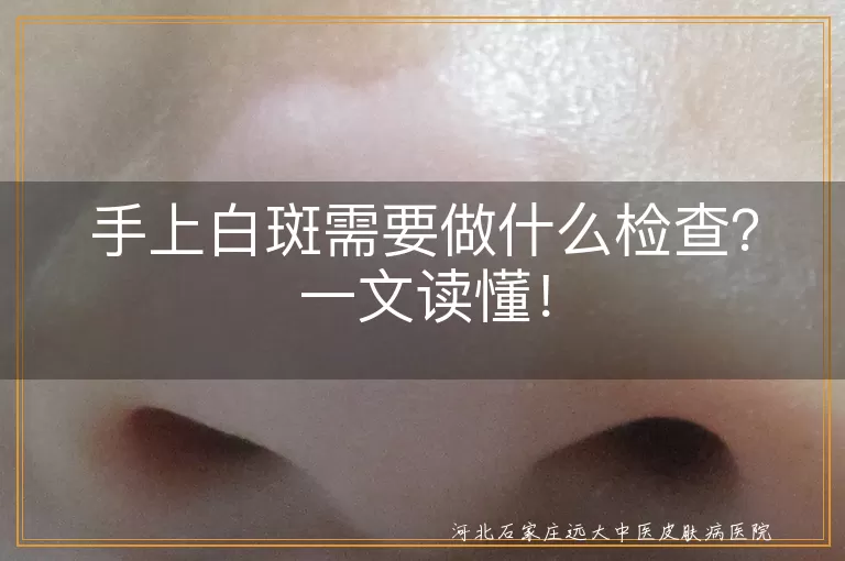 手上白斑,检查,Wood灯,血常规,皮肤组织活检,预防,护理