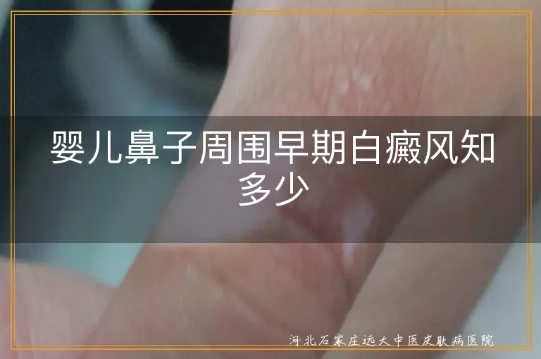 婴儿白癜风,皮肤白斑,边界清晰,皮肤敏感,遗传因素,免疫因素,就医治疗,日常护理