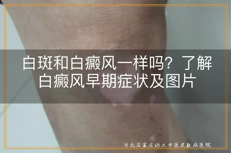 白斑,白癜风,早期症状,图片,治疗,皮肤护理